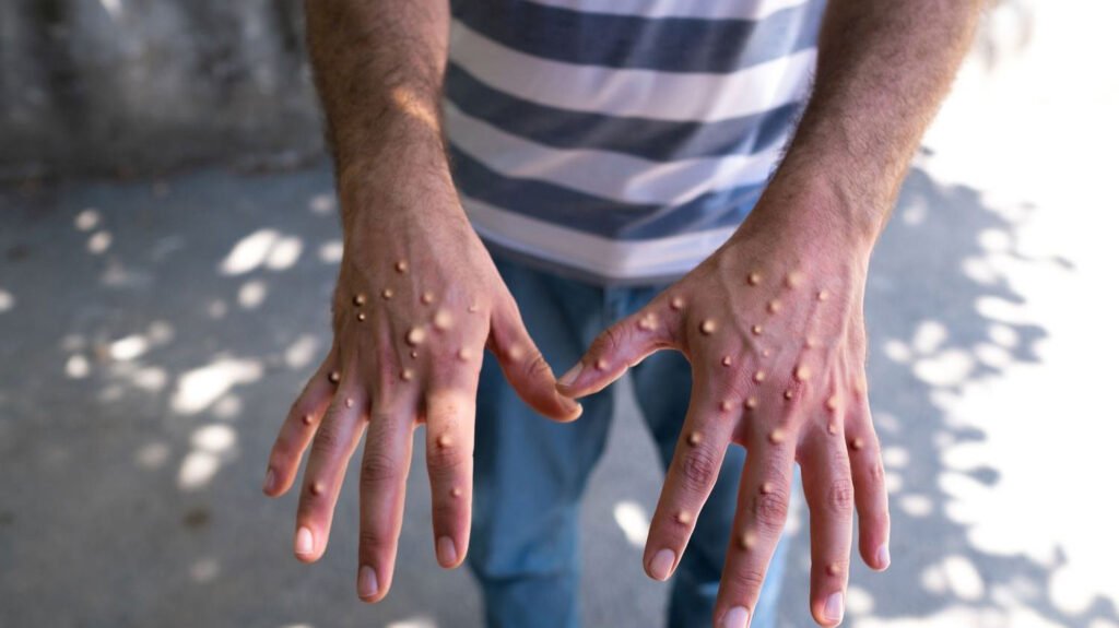 Mpox Symptoms, Early Signs, and Cure: What You Need to Know Mpox Symptoms